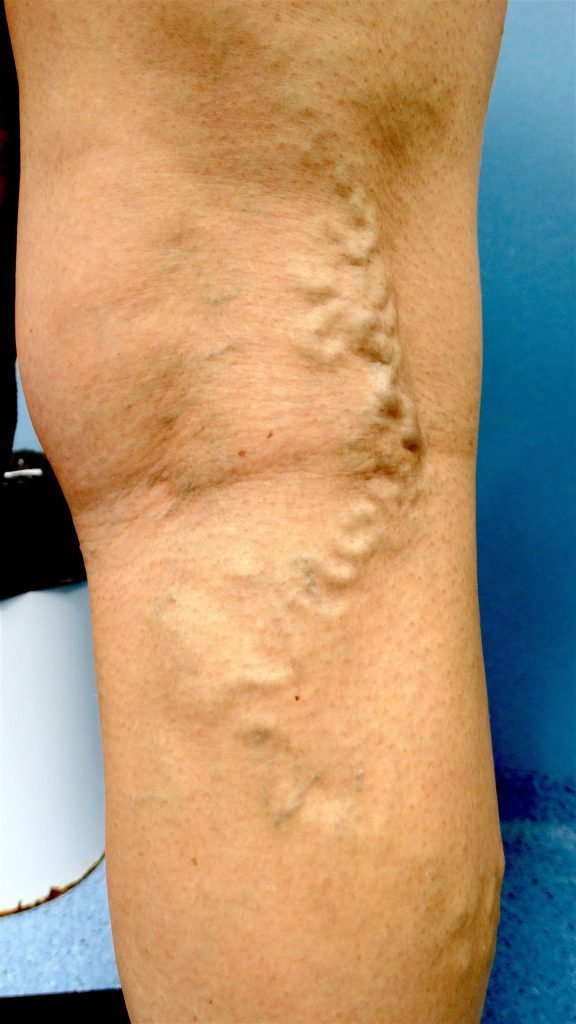 Tratamiento para eliminar las Varices sin Cirugía en Marbella (Málaga) MÉTODO IVEI Tratamiento para eliminar las Varices sin Cirugía en Marbella (Málaga) MÉTODO IVEI