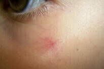 angioma_3856_s angioma_3856_s