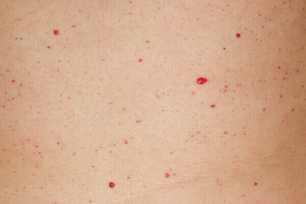 puntos-rubi puntos-rubi