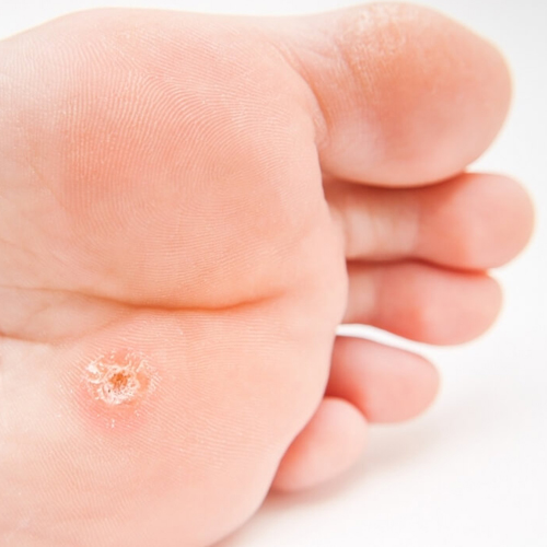 heridas-2